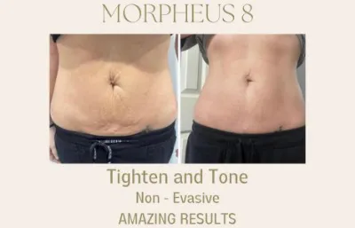 Before and after Morpheus8 treatment