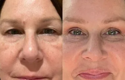 Before and after skin rejuvenation treatment
