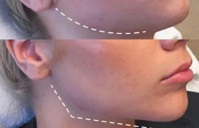 Facial contouring treatment before and after