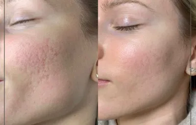 Before and after acne treatment