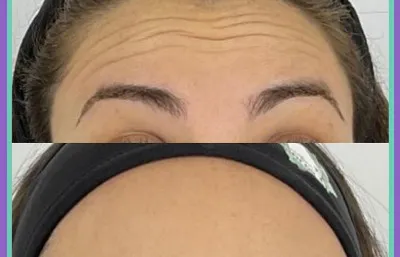 Before and after lines and wrinkles treatment