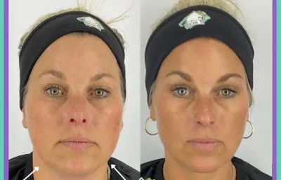 Before and after Radiofrequency treatment