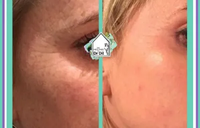 lines and wrinkles treatment before and after