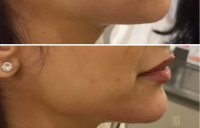 Before and after facial contouring treatment