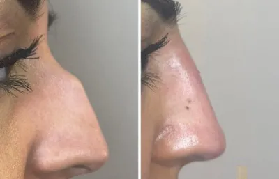 Before and after nose reshaping treatment