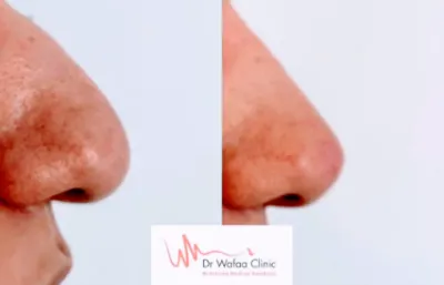 Nose augmentation before and after treatment image