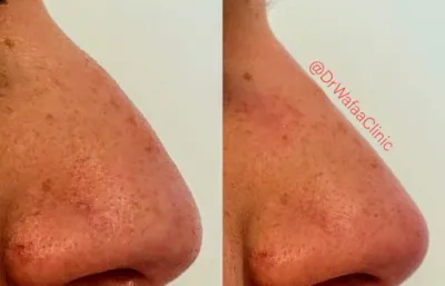 Nose reshaping treatment before and after
