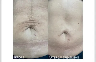 Before and after abdomen treatment