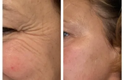 Before and after lines and wrinkles treatment