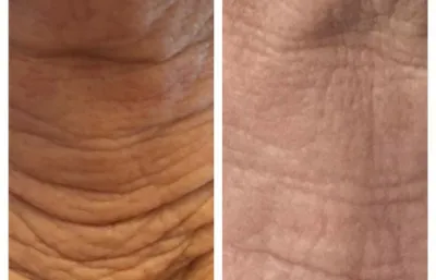Before and after Polynucleotides treatment
