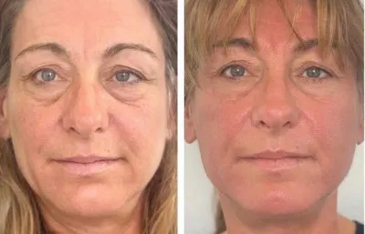 before and after facial rejuvenation treatment