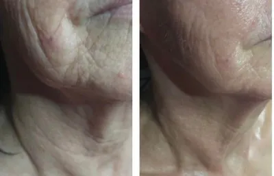 Before and after lines and wrinkles treatment