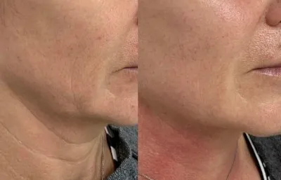 before and after skin rejuvenation treatment
