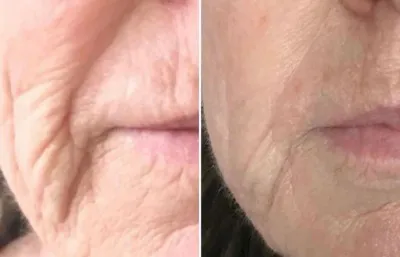 lines and wrinkle treatment before and after