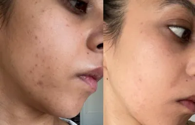 Before and after acne and pigmentation treatment