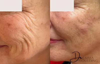 Before and after Line and wrinkle treatment