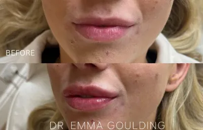 Before and after lip augmentation treatment