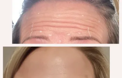 Before and after forehead lines and wrinkles treatment