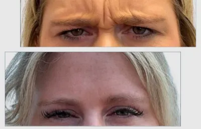 Before and after Frown line treatment