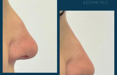 Before and after non-surgical rhinoplasty treatment