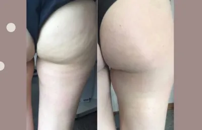 Before and after RF Pro treatment