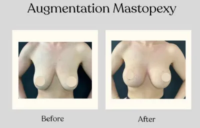 Before and after augmentation mastopexy treatment
