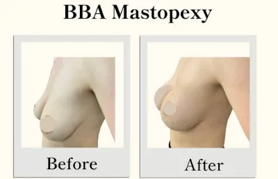 Before and after BBA Mastopexy treatment