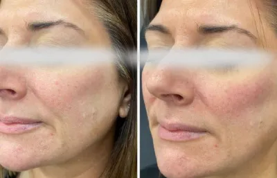 Before and after cheek/mid-face augmentation treatment