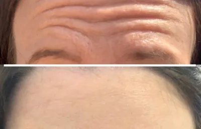 Before and after lines and wrinkles treatment