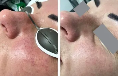 skin rejuvenation treatment before and after