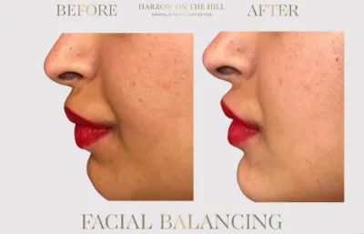 Before and after facial balancing treatment