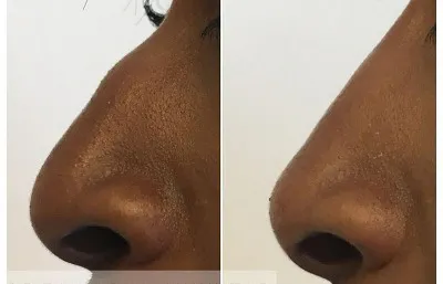 Before and after nose augmentation treatment