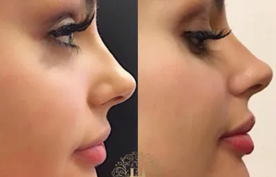 Before and after skin rejuvenation treatment