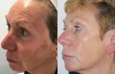 before and after HIFU and RF microneedling