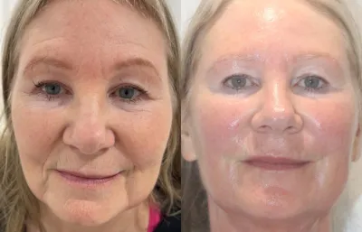 before and after HIFU
