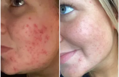 chemical peel results