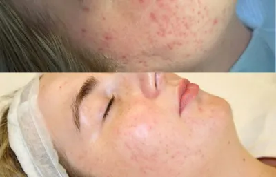 microneedling results