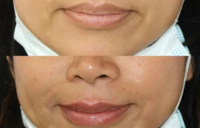 natural lip filler
