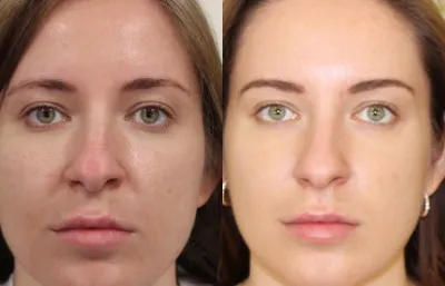 skin booster results