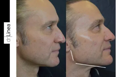 Before and after male facial augmentation treatment