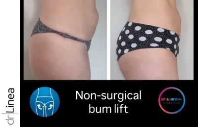 Before and after non-surgical treatment