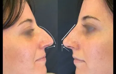 Before and after nose reshaping treatment