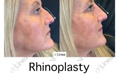 Before and after Rhinoplasty treatment