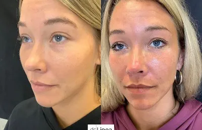 Before and after skin rejuvenation treatment