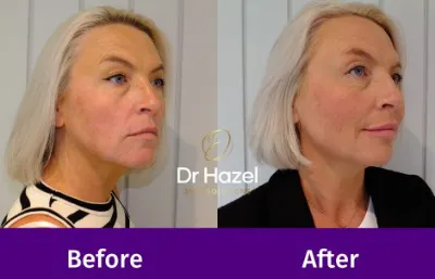 Before and after facial rejuvenation treatment