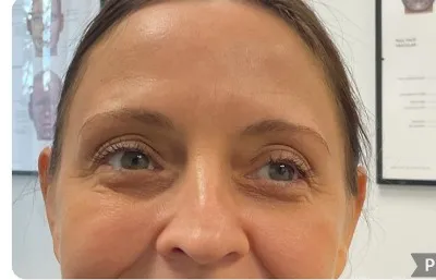 After lines and wrinkles treatment