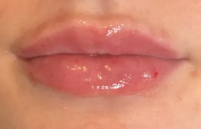 After lip volumising treatment