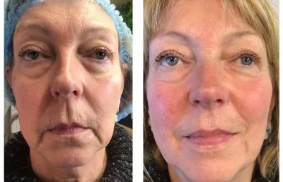 Before and after facial rejuvenation treatment