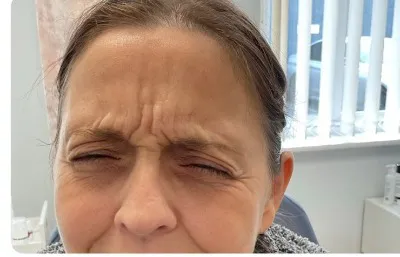 before lines and wrinkle treatment