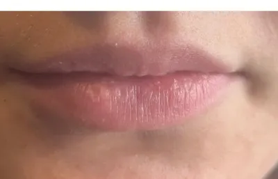 before lip volumising treatment